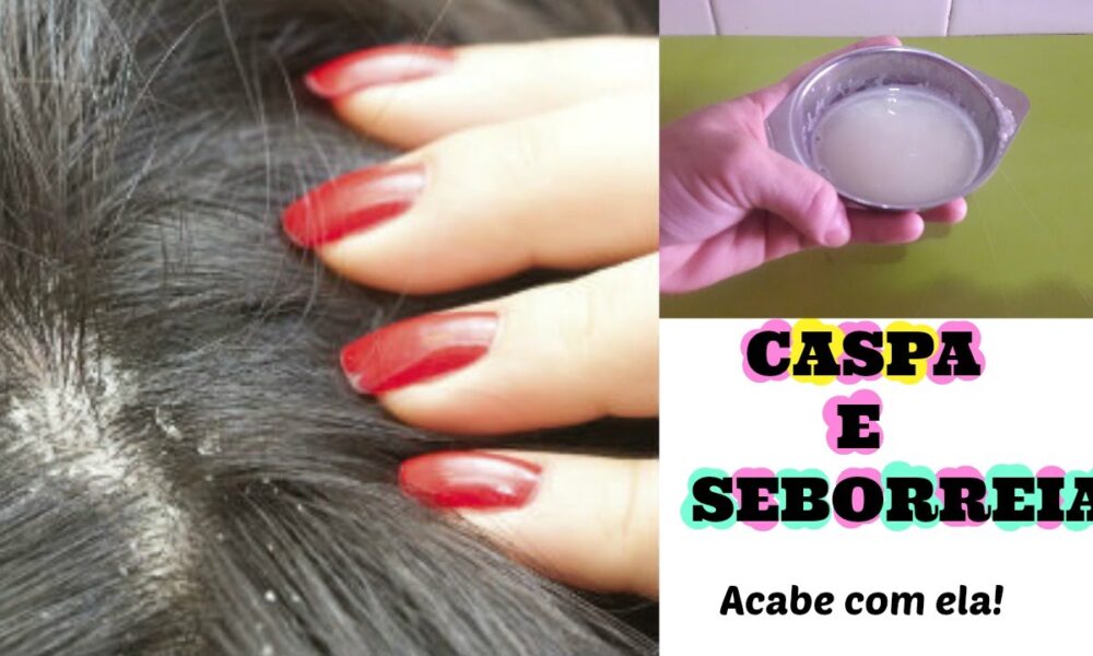 Como Eliminar A Caspa Seborreia E Fazer Crescer Muito O Cabelo