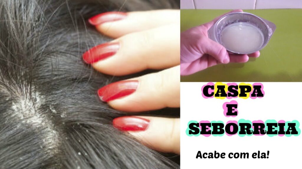 Como eliminar a caspa, seborreia e fazer crescer muito o cabelo