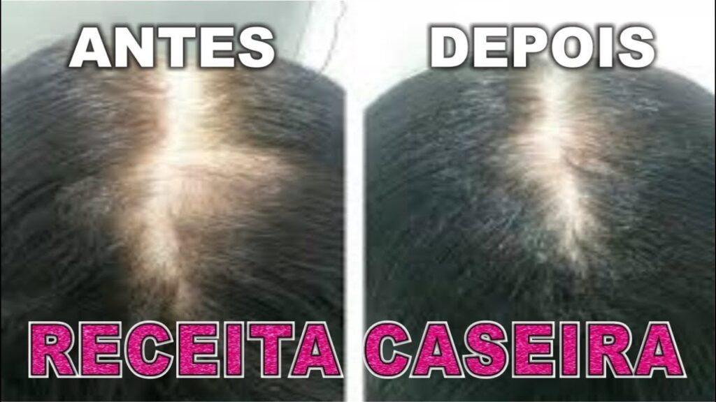 Como acabar com a queda de cabelo gastando pouco