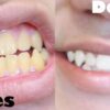 Receita caseira para clarear os dentes, fácil e eficaz