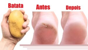 Diga adeus as rachaduras nos pés usando batata