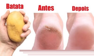 Diga adeus as rachaduras nos pés usando batata