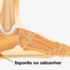 Aprenda a acabar com o esporão do calcanhar de forma simples