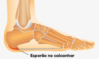 Aprenda a acabar com o esporão do calcanhar de forma simples