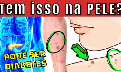 10 Principais sinais de diabetes na pele (aparecem se você tem muito açucar no sangue)