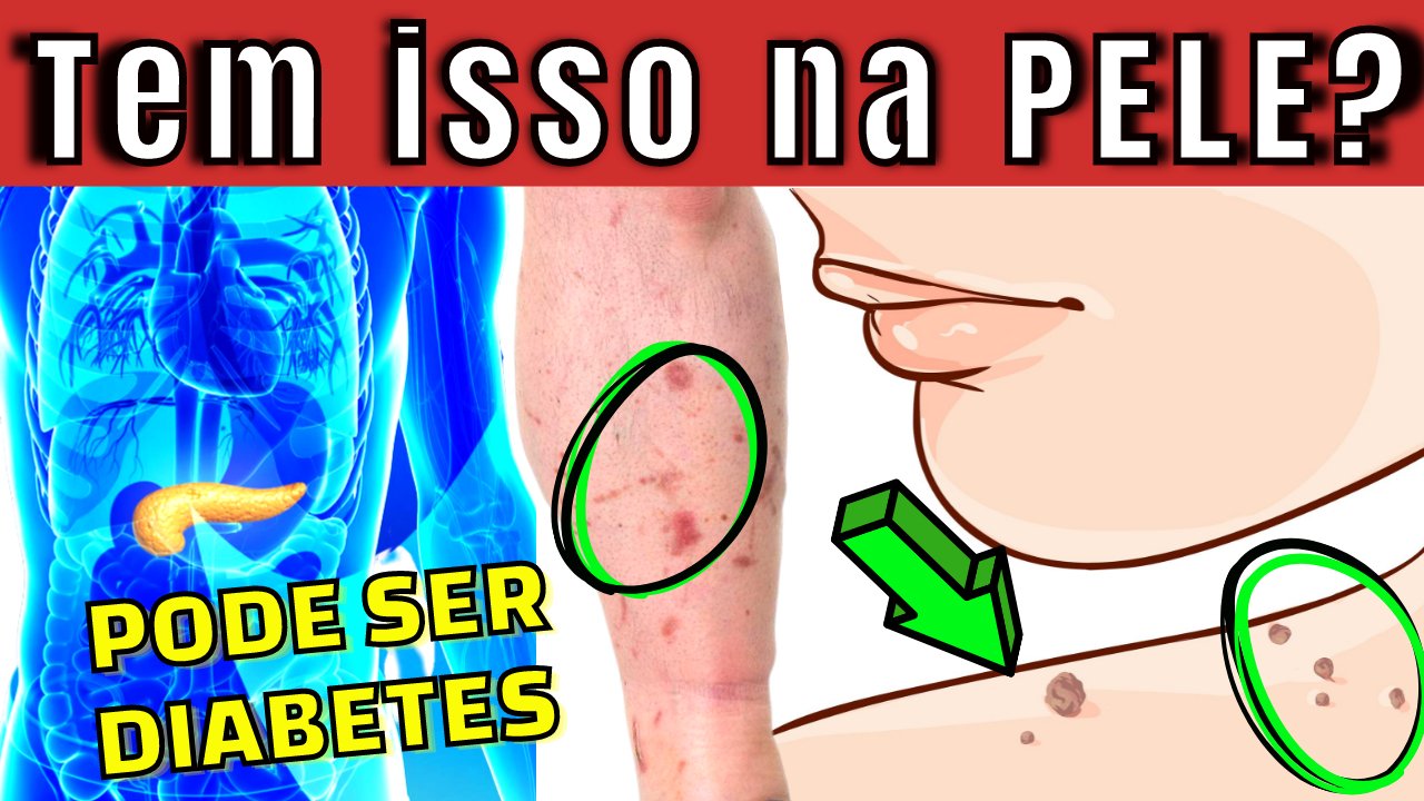 10 Principais sinais de diabetes na pele (aparecem se você tem muito açucar no sangue)