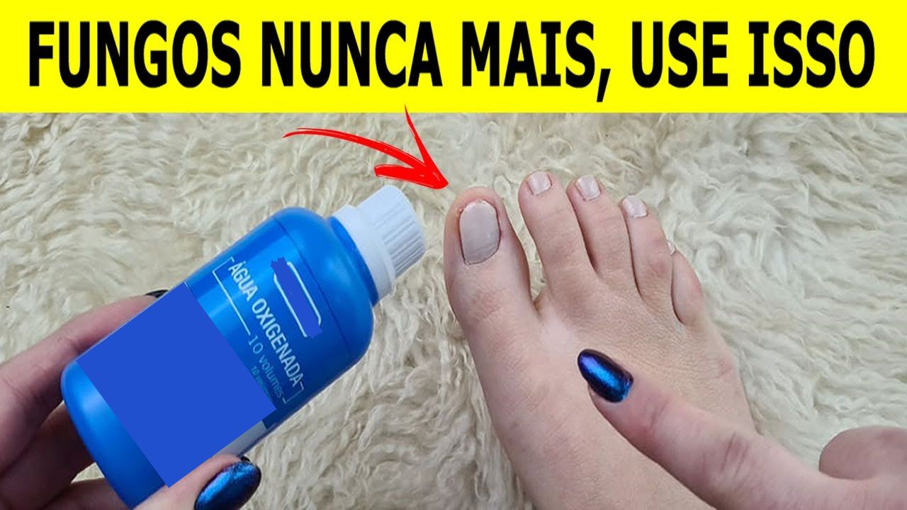 Nunca mais tive fungos e micose nas unhas depois que usei essa receita