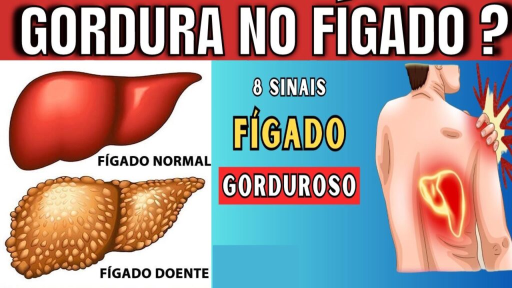 8 Sinais que Indicam Gordura no Fígado