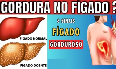 8 Sinais que Indicam Gordura no Fígado