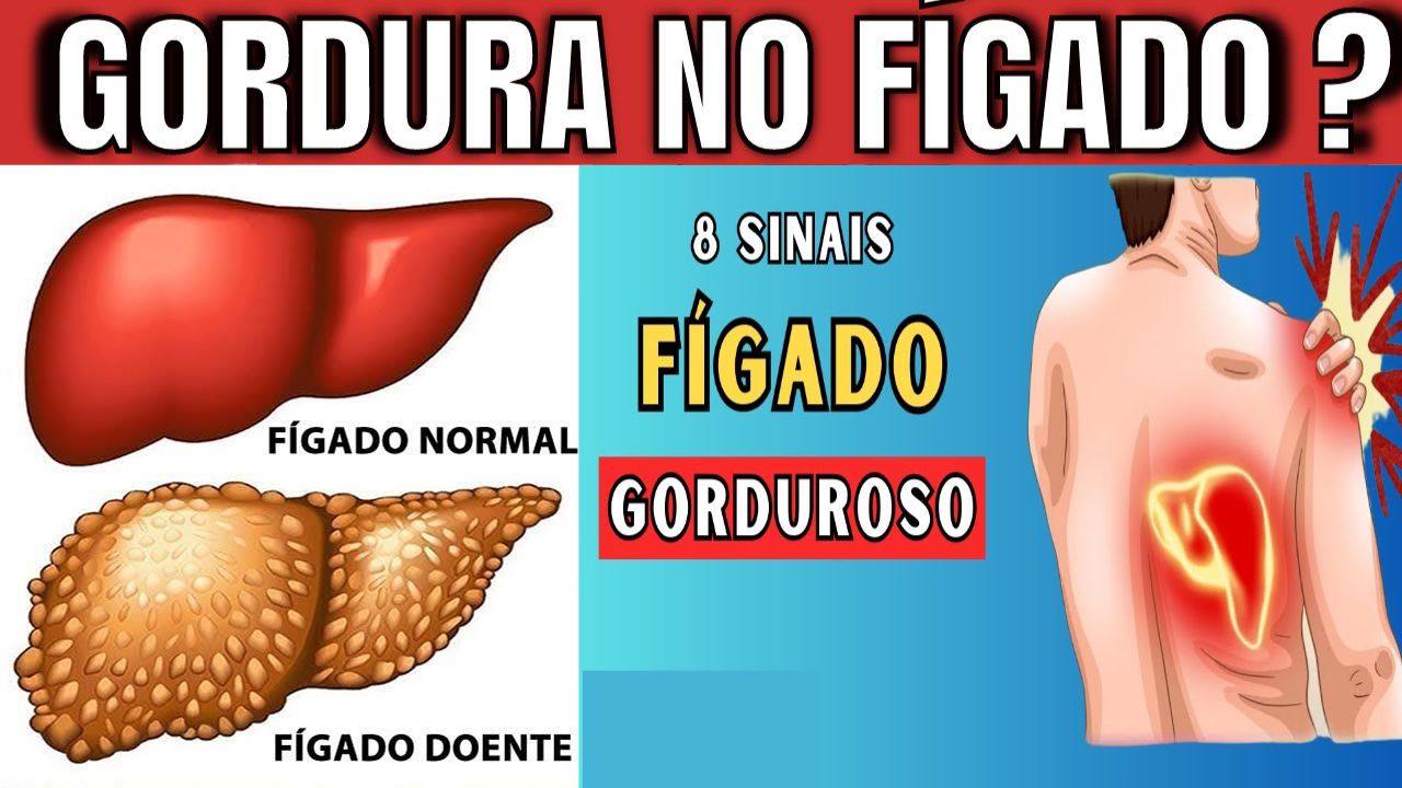 8 Sinais que Indicam Gordura no Fígado